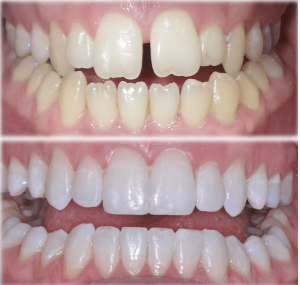 align bleech bond wales
