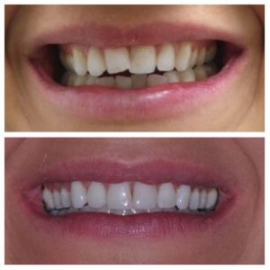 Invisalign in Cardiff - Dental Implants in Cardiff - Invisible Braces in Cardiff - Cosmetic dentist Cardiff - Invisalign in Newport