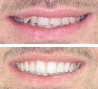 cosmetic veneers