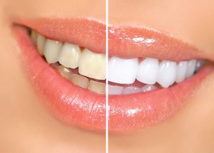 dental teeth whitening cardiff
