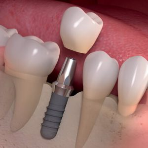 dental implant