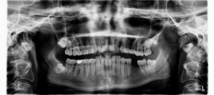 x-ray dental implants 