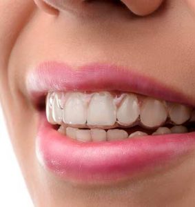 What is Invisalign?