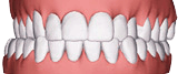 Crossbite