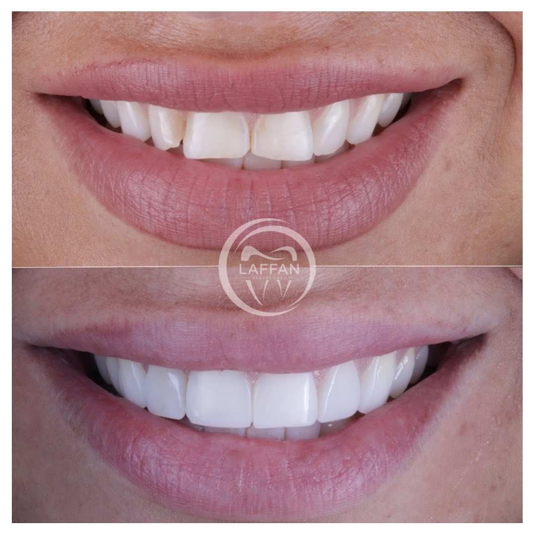 Dental Veneer